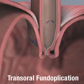 trans-oral Fundoplication with TIF Esophyx